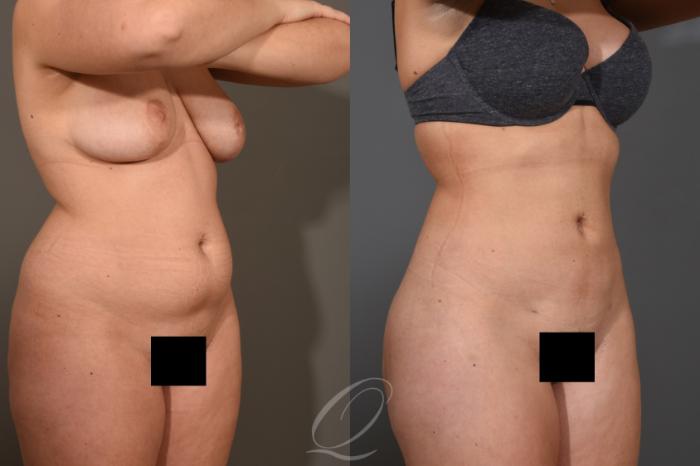 Liposuction Case 1462 Before & After Right Oblique | Serving Rochester, Syracuse & Buffalo, NY | Quatela Center for Plastic Surgery