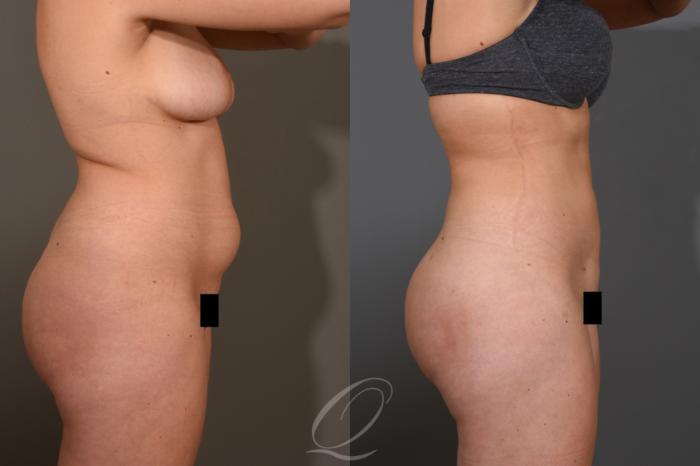 Liposuction Case 1462 Before & After Right Side | Serving Rochester, Syracuse & Buffalo, NY | Quatela Center for Plastic Surgery