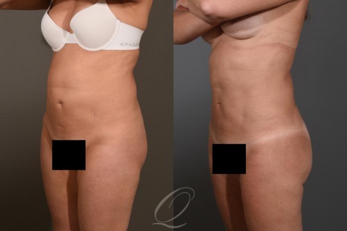 Liposuction Case 1476 Before & After Left Oblique | Serving Rochester, Syracuse & Buffalo, NY | Quatela Center for Plastic Surgery