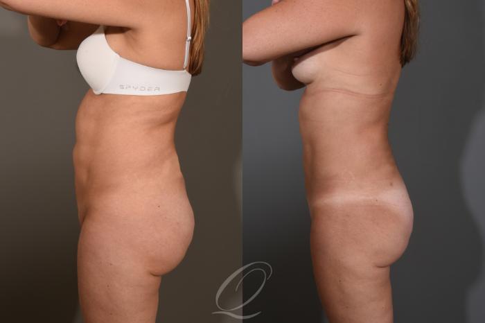 Liposuction Case 1476 Before & After Left Side | Serving Rochester, Syracuse & Buffalo, NY | Quatela Center for Plastic Surgery