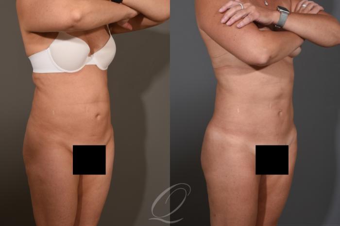 Liposuction Case 1476 Before & After Right Oblique | Serving Rochester, Syracuse & Buffalo, NY | Quatela Center for Plastic Surgery