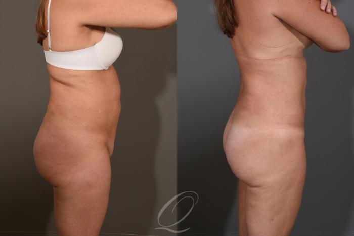 Liposuction Case 1476 Before & After Right Side | Serving Rochester, Syracuse & Buffalo, NY | Quatela Center for Plastic Surgery