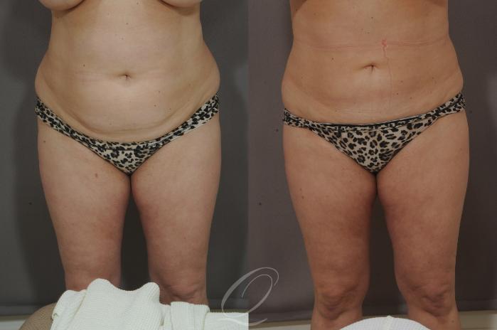 Liposuction Case 210 Before & After View #1 | Serving Rochester, Syracuse & Buffalo, NY | Quatela Center for Plastic Surgery