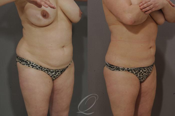 Liposuction Case 210 Before & After View #2 | Serving Rochester, Syracuse & Buffalo, NY | Quatela Center for Plastic Surgery