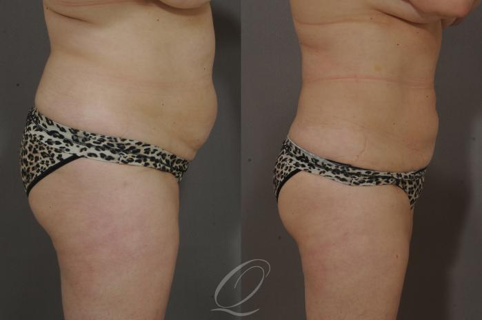Liposuction Case 210 Before & After View #3 | Serving Rochester, Syracuse & Buffalo, NY | Quatela Center for Plastic Surgery