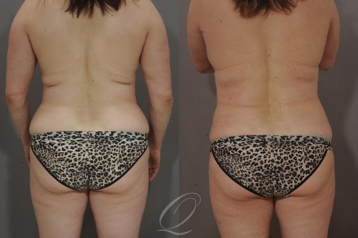 Liposuction Case 210 Before & After View #4 | Serving Rochester, Syracuse & Buffalo, NY | Quatela Center for Plastic Surgery