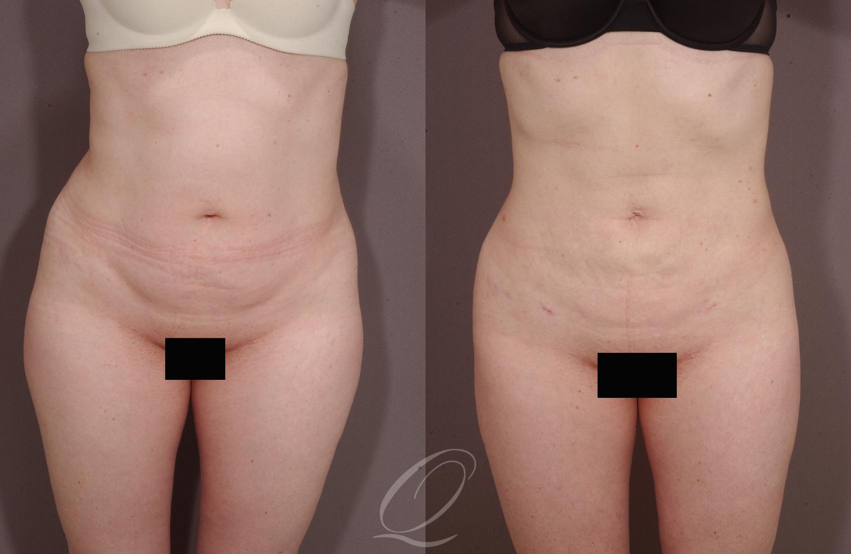Liposuction Case 211 Before & After View #1 | Serving Rochester, Syracuse & Buffalo, NY | Quatela Center for Plastic Surgery