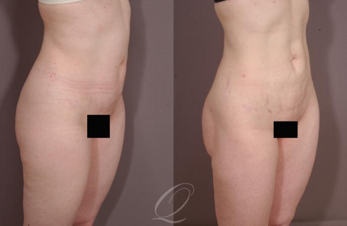 Liposuction Case 211 Before & After View #2 | Serving Rochester, Syracuse & Buffalo, NY | Quatela Center for Plastic Surgery