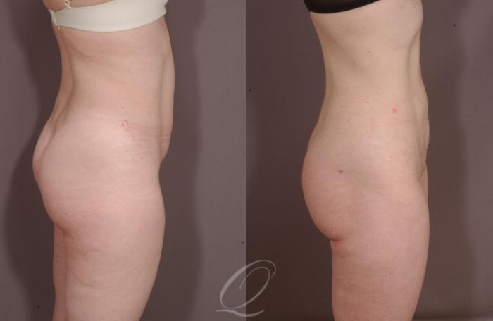 Liposuction Case 211 Before & After View #3 | Serving Rochester, Syracuse & Buffalo, NY | Quatela Center for Plastic Surgery