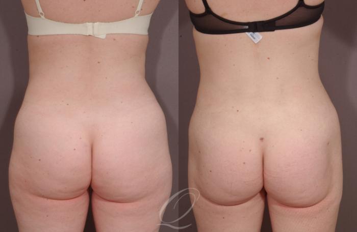 Liposuction Case 211 Before & After View #4 | Serving Rochester, Syracuse & Buffalo, NY | Quatela Center for Plastic Surgery