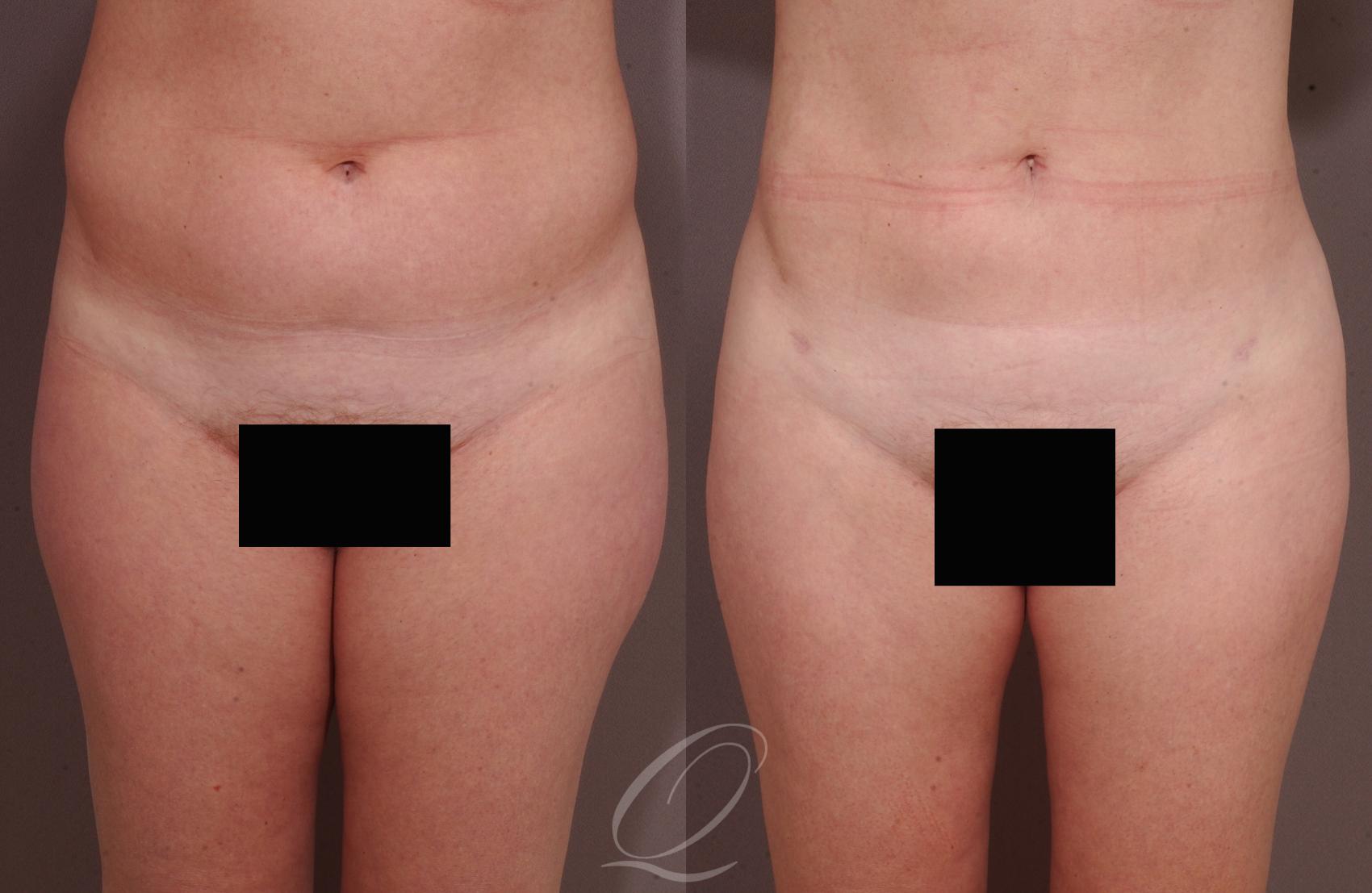 Liposuction Case 212 Before & After View #1 | Serving Rochester, Syracuse & Buffalo, NY | Quatela Center for Plastic Surgery
