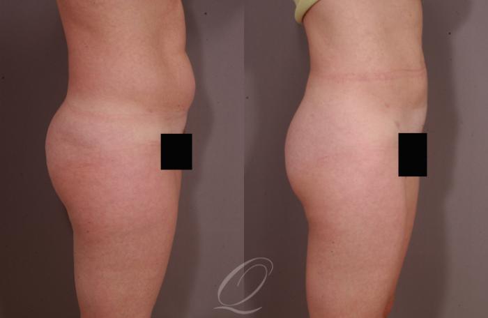 Liposuction Case 212 Before & After View #2 | Serving Rochester, Syracuse & Buffalo, NY | Quatela Center for Plastic Surgery