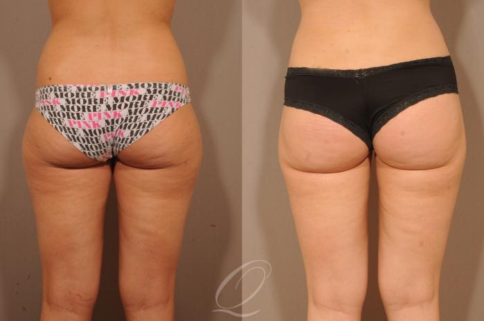 Liposuction Case 213 Before & After View #2 | Serving Rochester, Syracuse & Buffalo, NY | Quatela Center for Plastic Surgery