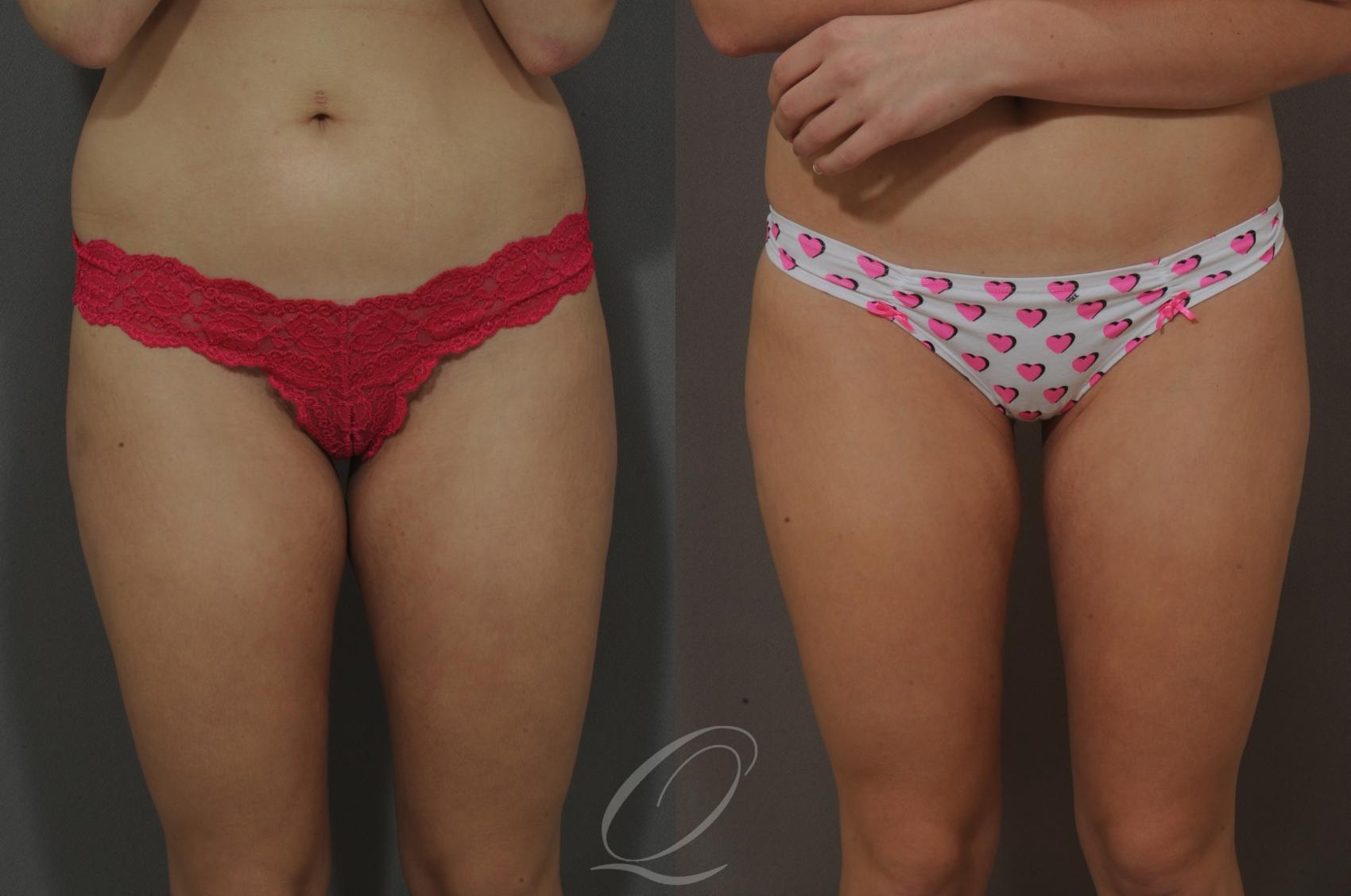 Liposuction Case 219 Before & After View #1 | Serving Rochester, Syracuse & Buffalo, NY | Quatela Center for Plastic Surgery