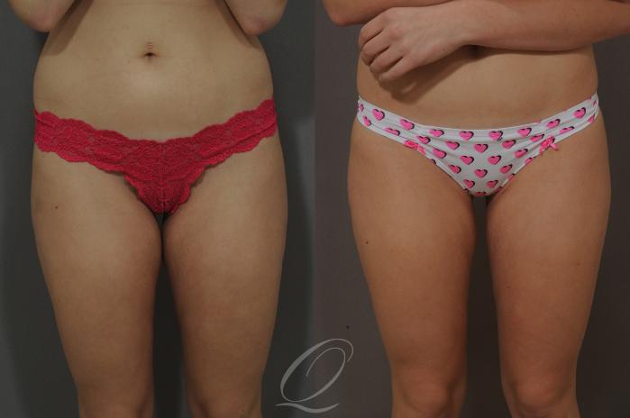 Liposuction Before & After Photos Patient 219, Serving Rochester, Syracuse  & Buffalo, NY