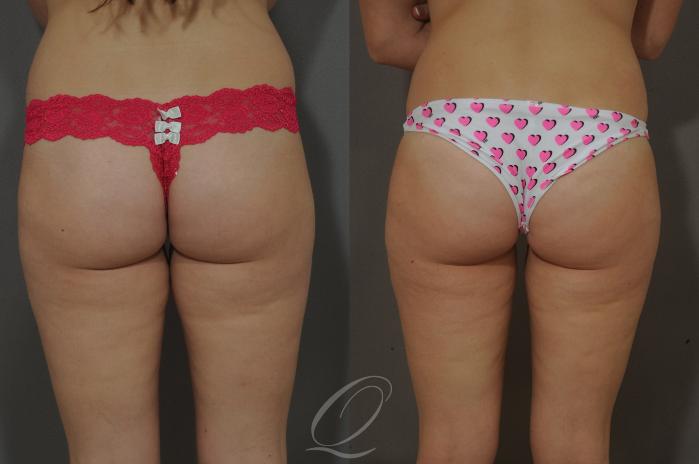 Liposuction Case 219 Before & After View #2 | Serving Rochester, Syracuse & Buffalo, NY | Quatela Center for Plastic Surgery