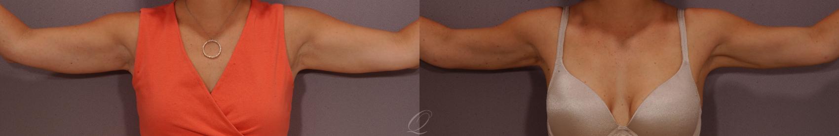 Liposuction Case 272 Before & After View #1 | Serving Rochester, Syracuse & Buffalo, NY | Quatela Center for Plastic Surgery