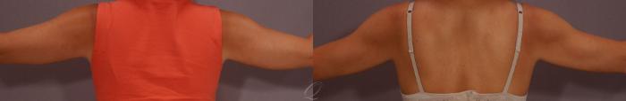 Liposuction Case 272 Before & After View #2 | Serving Rochester, Syracuse & Buffalo, NY | Quatela Center for Plastic Surgery
