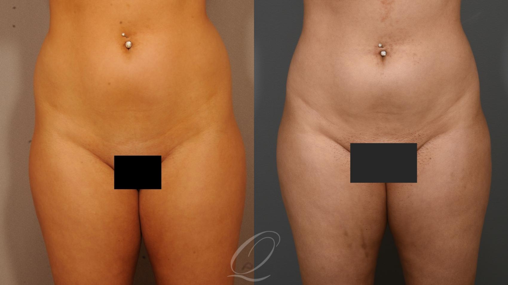 Liposuction Case 273 Before & After View #1 | Serving Rochester, Syracuse & Buffalo, NY | Quatela Center for Plastic Surgery
