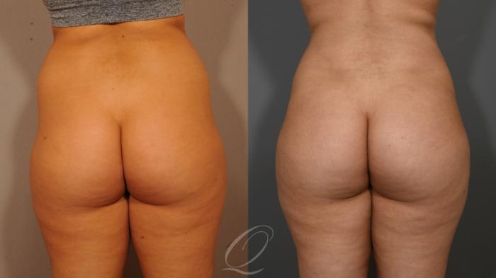 Liposuction Case 273 Before & After View #4 | Serving Rochester, Syracuse & Buffalo, NY | Quatela Center for Plastic Surgery