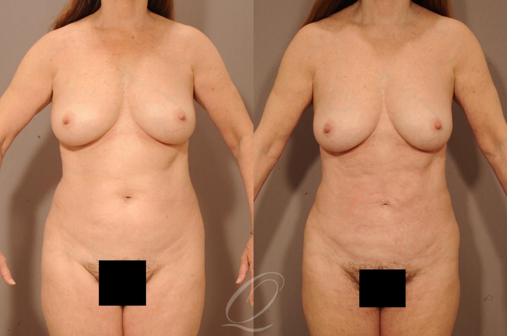 Liposuction Case 283 Before & After View #1 | Serving Rochester, Syracuse & Buffalo, NY | Quatela Center for Plastic Surgery