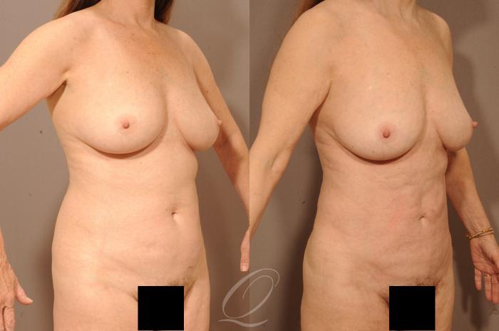Liposuction Case 283 Before & After View #2 | Serving Rochester, Syracuse & Buffalo, NY | Quatela Center for Plastic Surgery