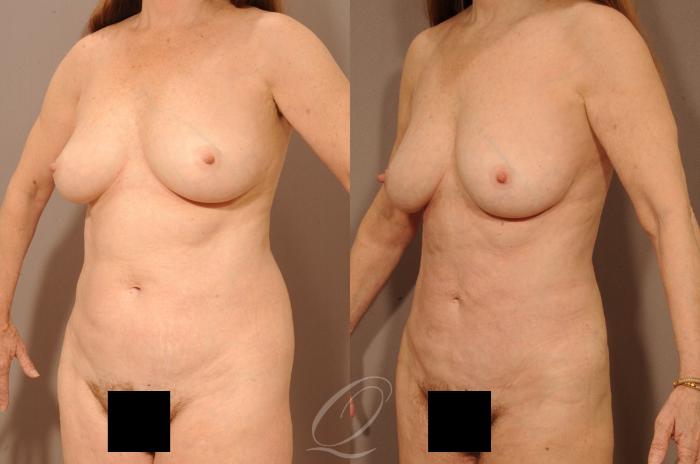 Liposuction Case 283 Before & After View #4 | Serving Rochester, Syracuse & Buffalo, NY | Quatela Center for Plastic Surgery