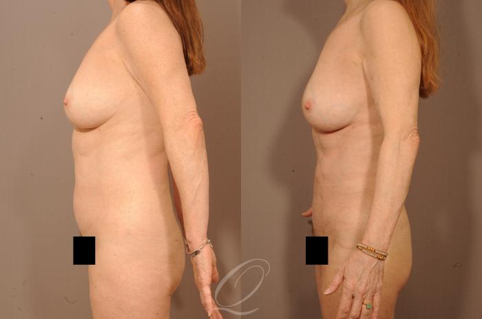 Liposuction Case 283 Before & After View #5 | Serving Rochester, Syracuse & Buffalo, NY | Quatela Center for Plastic Surgery