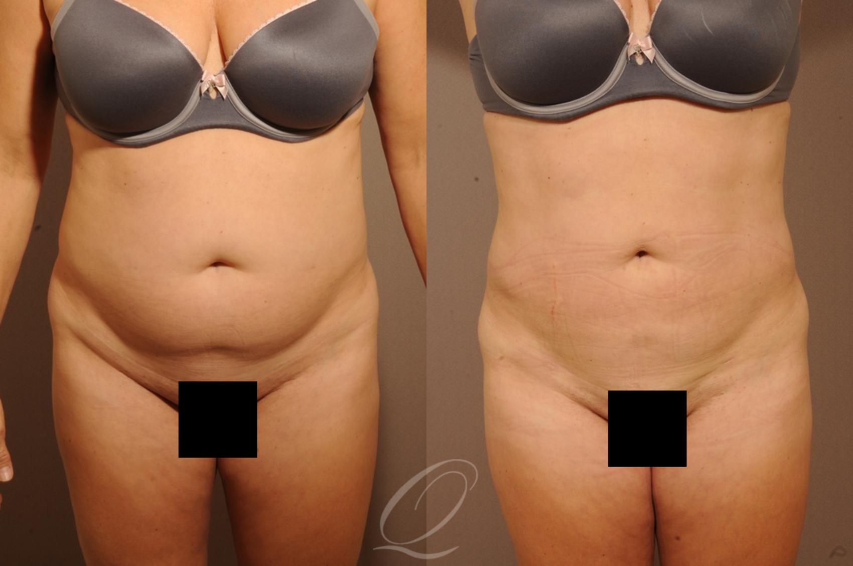 Liposuction Case 284 Before & After View #1 | Serving Rochester, Syracuse & Buffalo, NY | Quatela Center for Plastic Surgery
