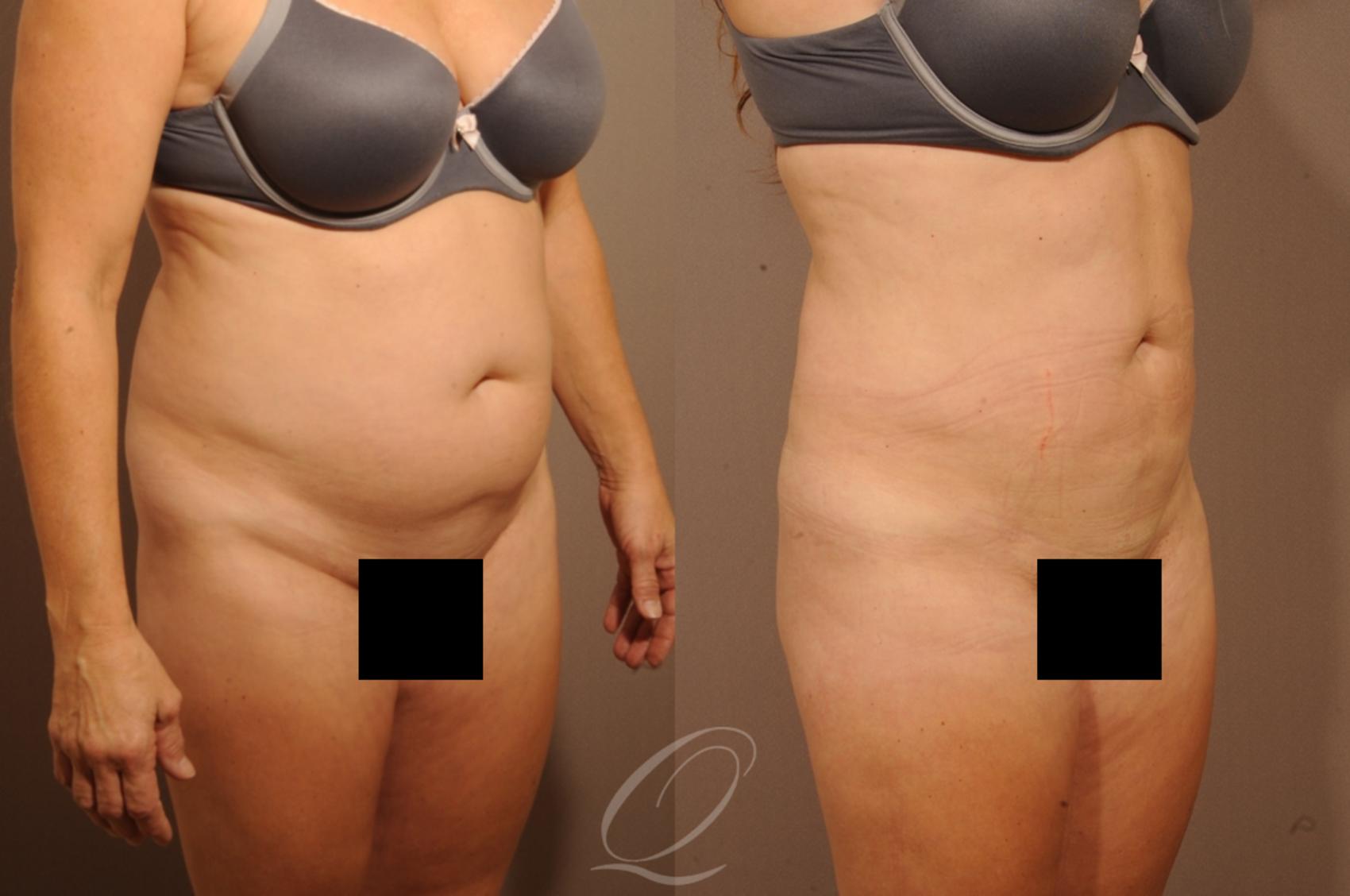 Liposuction Case 284 Before & After View #2 | Serving Rochester, Syracuse & Buffalo, NY | Quatela Center for Plastic Surgery
