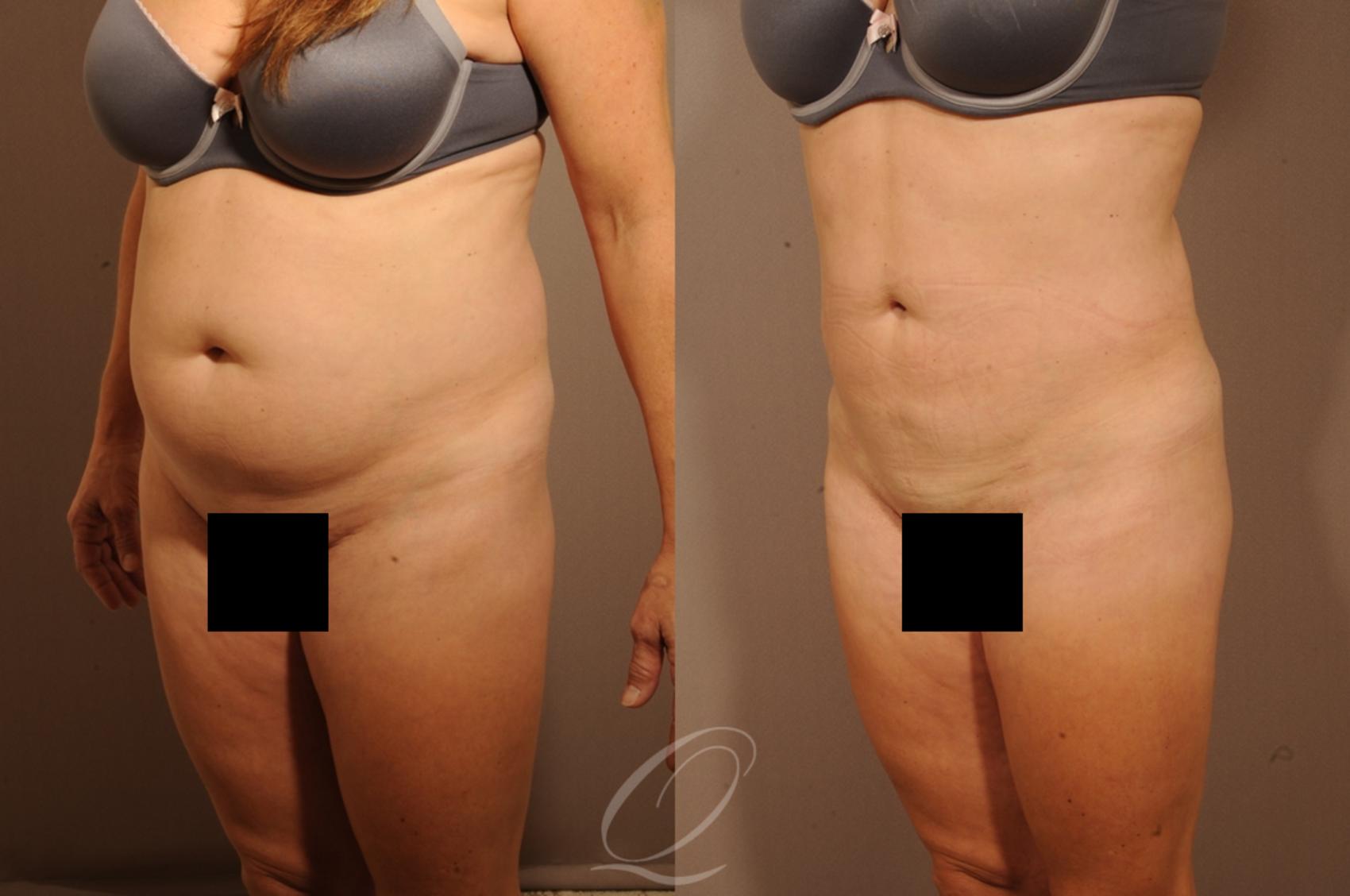 Liposuction Case 284 Before & After View #3 | Serving Rochester, Syracuse & Buffalo, NY | Quatela Center for Plastic Surgery