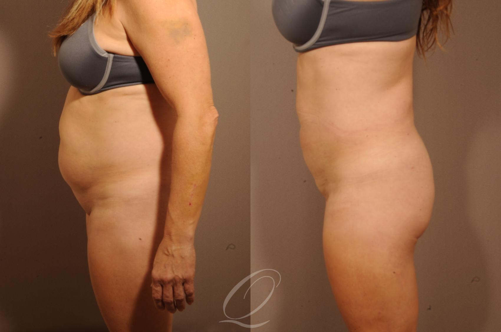 Liposuction Case 284 Before & After View #4 | Serving Rochester, Syracuse & Buffalo, NY | Quatela Center for Plastic Surgery