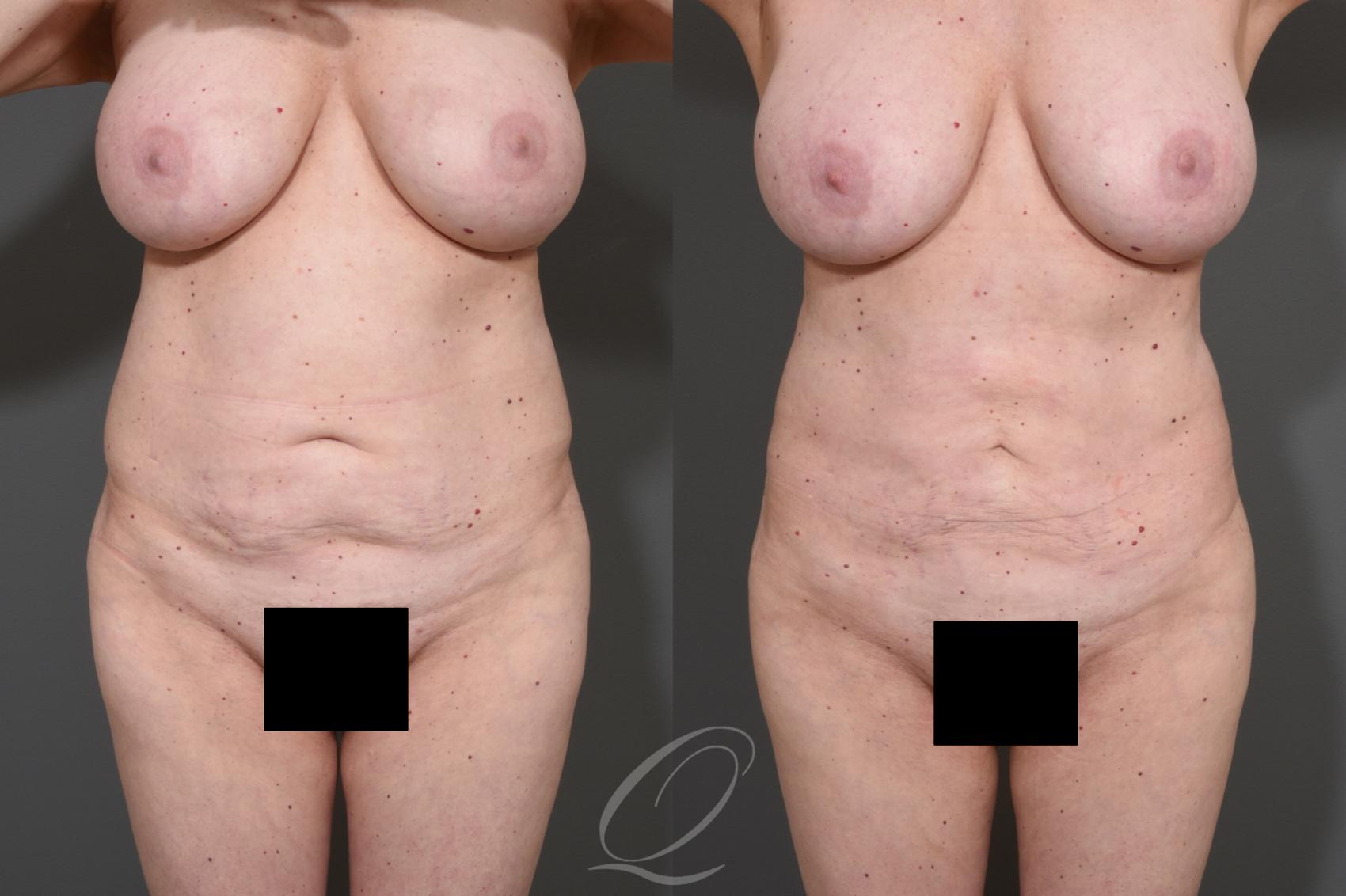 Liposuction Case 341 Before & After View #1 | Serving Rochester, Syracuse & Buffalo, NY | Quatela Center for Plastic Surgery