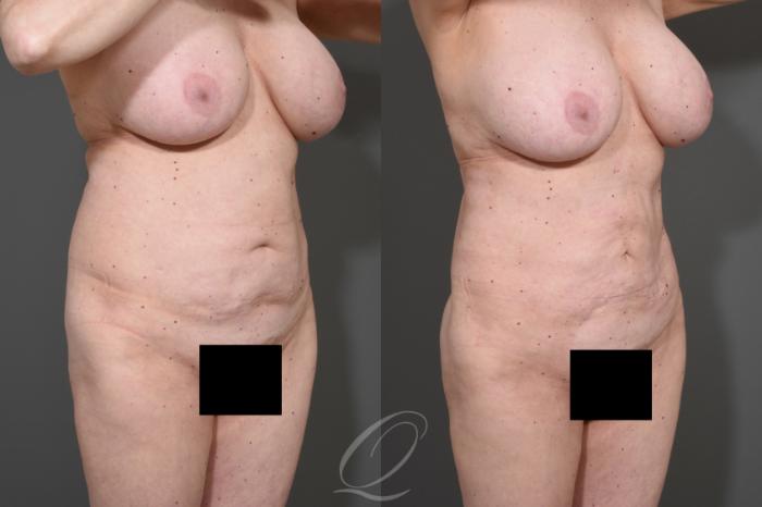 Liposuction Case 341 Before & After View #2 | Serving Rochester, Syracuse & Buffalo, NY | Quatela Center for Plastic Surgery