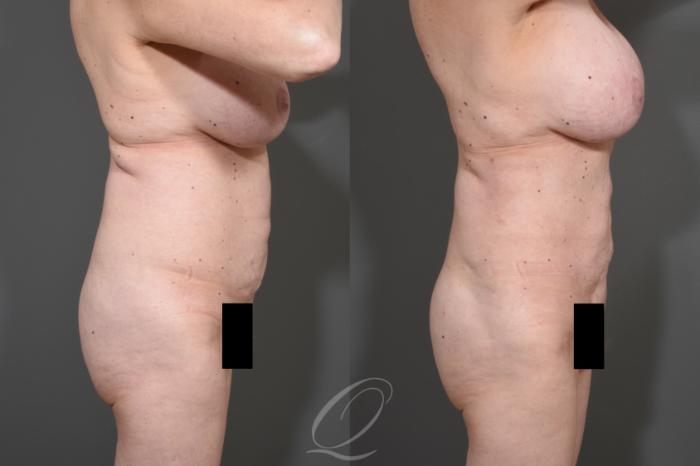 Liposuction Case 341 Before & After View #3 | Serving Rochester, Syracuse & Buffalo, NY | Quatela Center for Plastic Surgery