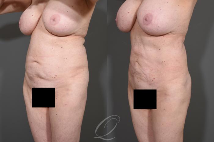 Liposuction Case 341 Before & After View #4 | Serving Rochester, Syracuse & Buffalo, NY | Quatela Center for Plastic Surgery