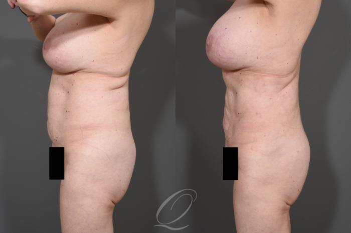 Liposuction Case 341 Before & After View #5 | Serving Rochester, Syracuse & Buffalo, NY | Quatela Center for Plastic Surgery