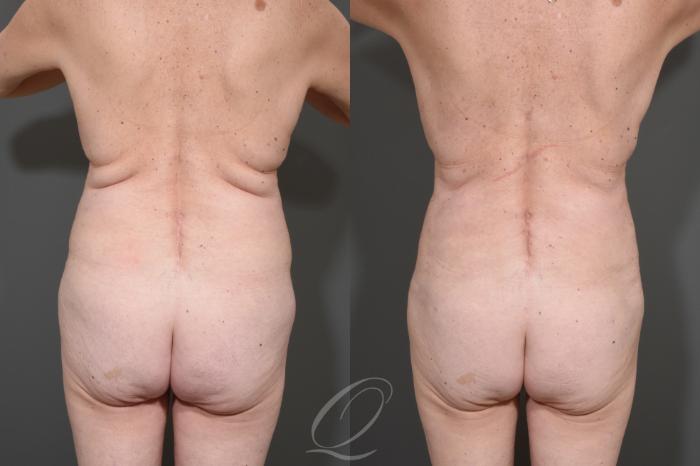 Liposuction Case 341 Before & After View #6 | Serving Rochester, Syracuse & Buffalo, NY | Quatela Center for Plastic Surgery