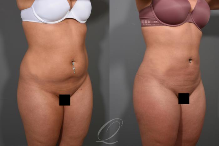Liposuction Case 366 Before & After View #2 | Serving Rochester, Syracuse & Buffalo, NY | Quatela Center for Plastic Surgery