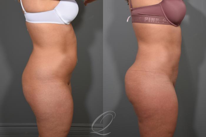 Liposuction Case 366 Before & After View #3 | Serving Rochester, Syracuse & Buffalo, NY | Quatela Center for Plastic Surgery