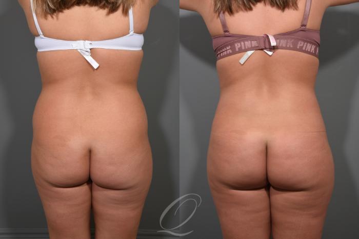 Liposuction Case 366 Before & After View #4 | Serving Rochester, Syracuse & Buffalo, NY | Quatela Center for Plastic Surgery