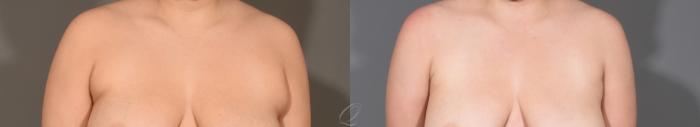 Liposuction Case 391 Before & After Front | Serving Rochester, Syracuse & Buffalo, NY | Quatela Center for Plastic Surgery