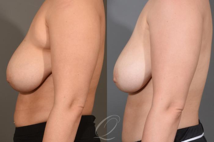 Liposuction Case 391 Before & After Left Side | Serving Rochester, Syracuse & Buffalo, NY | Quatela Center for Plastic Surgery