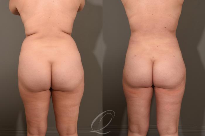 Liposuction Case 413 Before & After Back | Serving Rochester, Syracuse & Buffalo, NY | Quatela Center for Plastic Surgery
