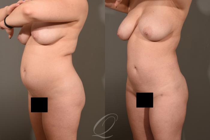Liposuction Case 413 Before & After Left Oblique | Serving Rochester, Syracuse & Buffalo, NY | Quatela Center for Plastic Surgery