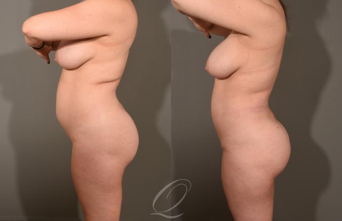 Liposuction Case 413 Before & After Left Side | Serving Rochester, Syracuse & Buffalo, NY | Quatela Center for Plastic Surgery