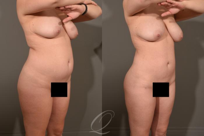 Liposuction Case 413 Before & After Right Oblique | Serving Rochester, Syracuse & Buffalo, NY | Quatela Center for Plastic Surgery