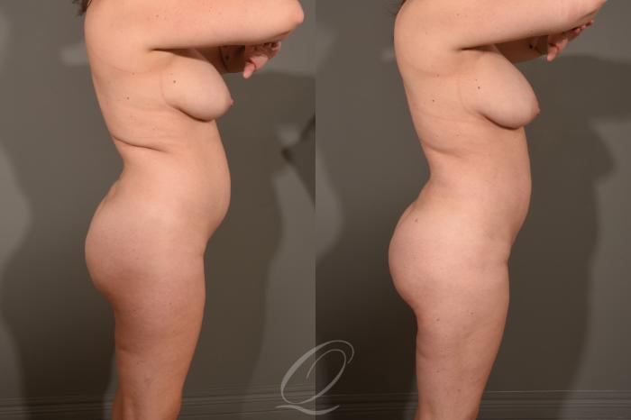Liposuction Case 413 Before & After Right Side | Serving Rochester, Syracuse & Buffalo, NY | Quatela Center for Plastic Surgery