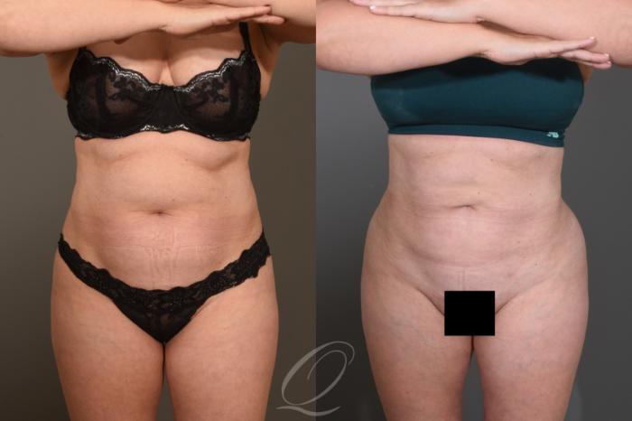 Liposuction Case 414 Before & After Front | Serving Rochester, Syracuse & Buffalo, NY | Quatela Center for Plastic Surgery