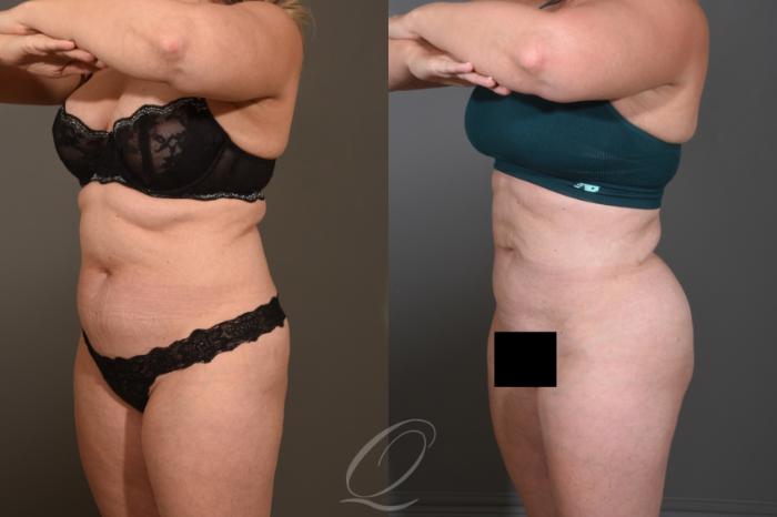 Liposuction Case 414 Before & After Left Oblique | Serving Rochester, Syracuse & Buffalo, NY | Quatela Center for Plastic Surgery